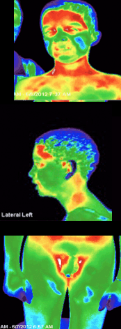 Thermal Images After SWC - Child with Autism